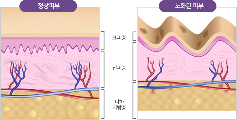 정상피부와 노화된피부 비교